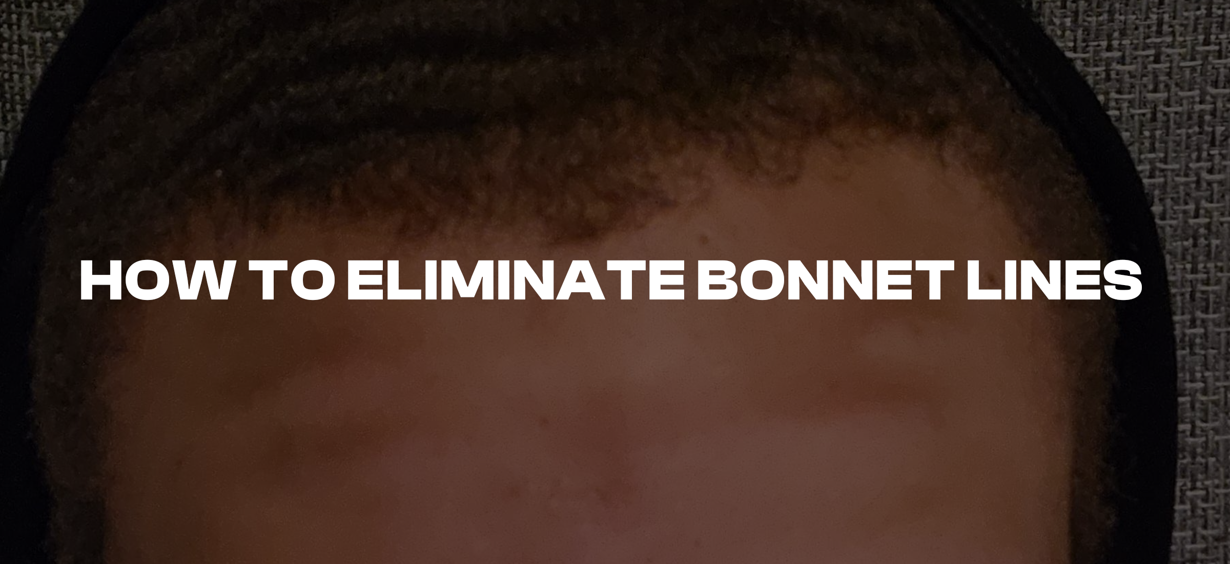How to Eliminate Bonnet Lines on Your Forehead: Expert Tips and Tricks